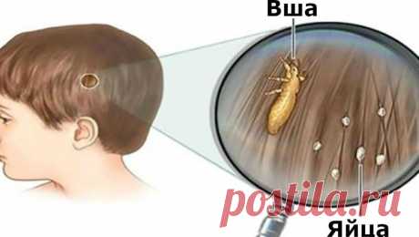 Секрет избавления от вшей о котором не расскажут в больнице
