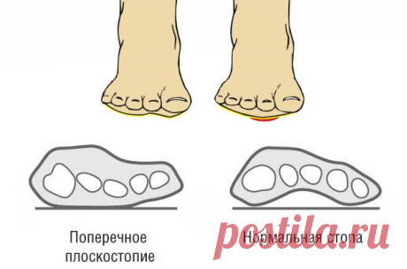 Коррекция поперечного плоскостопия | Доктор Гульнара Мазитова | Яндекс Дзен
