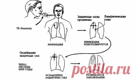 Открытая форма туберкулеза: признаки и симптомы, как передается?