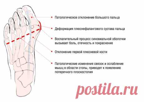 Косточки на ногах: избавляемся просто и без боли. И операции не нужно - медиаплатформа МирТесен От косточек на ногах мне помог избавиться йод. Я по несколько раз в день мыла ноги теплой водой, вытирала насухо, а потом обрабатывала косточки йодом. Так делала ежедневно, не пропуская ни одного дня, пока косточек не стало. Уже много лет они о себе не напоминают. Если болят суставы, и тут мне йод...