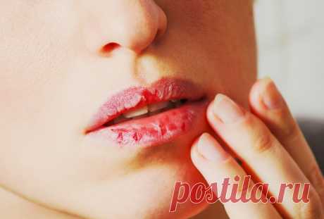 Обветренные губы или хейлит - причины и лечение болезни &amp;raquo; Женский Мир