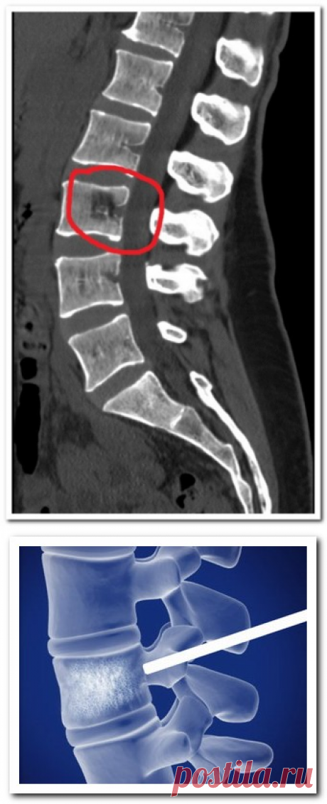 Гемангиома позвоночника - это не смертельно - Болезни позвоночника и суставов