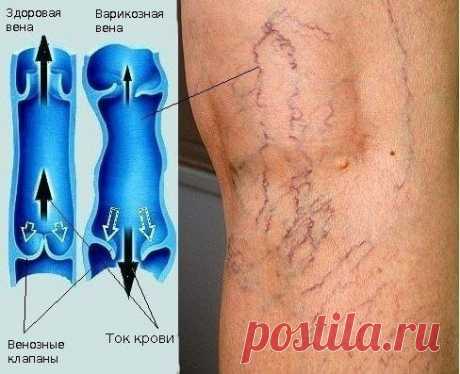 О варикозном расширении вен

Эту болезнь в восточной медицине связывают с болезнью Холода, опустившегося в нижнюю часть тела. Холод – сочетание Ветра (Вата-доша) и Слизи (Капха-доша) в различных пропорциях – это в первую очередь недостаток кровообращения.

Избыток Капхи может проявляться “вязкой” “жирной” кровью, которой просто трудно свободно двигаться по сосудам, избыток Ваты – недостаточной эластичностью, хрупкостью сосудов. Болезни Капхи лечатся очень хорошо регулярной...