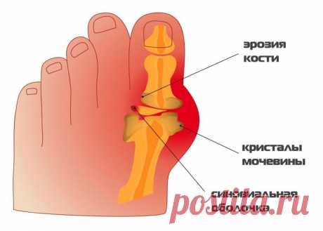 Как устранить боль при подагре Есть несколько вещей в человеческой жизни, которые могут конкурировать с болью подагры: будь то болезни богача или болезнь короля, мы все знаем, что