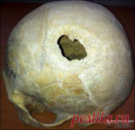 Древние алтайцы практиковали трепанацию черепа