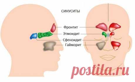 Синусит - симптомы, лечение, причины, диагностика и профилактика