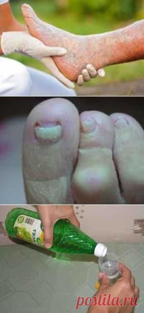 Грибок на ногтях ног, лечение для пожилых.