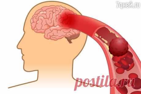 Инсульт: как предотвратить закупорку или разрыв мозгового сосуда - 7Дней.ру