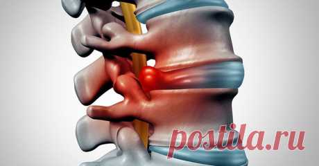 Как вылечить межпозвоночную грыжу при помощи физических упражнений Межпозвоночная грыжа чаще всего является следствием заболевания остеохондрозом. Однако если ее вовремя не начать лечить, последствия могут быть довольно плачевными, вплоть до паралича и даже летальног…