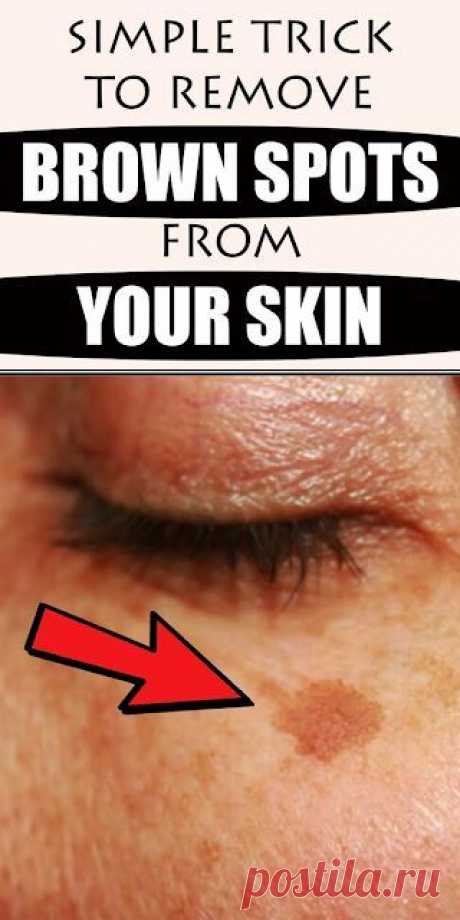 Simple Trick To Remove Brown Spots From Your Skin