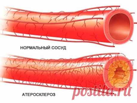 Как очистить артерии за месяц. Народное средство