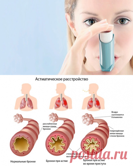 Чтобы приступ не застал врасплох: выбираем лекарство от астмы