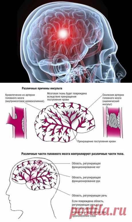 Что такое инсульт и как его можно предотвратить