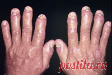 Артрит пальцев рук: причины, симптомы, лечение (фото)