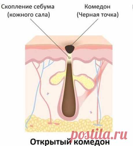 Сода от черных точек на лице: как сделать и применять маску и скраб, отзывы