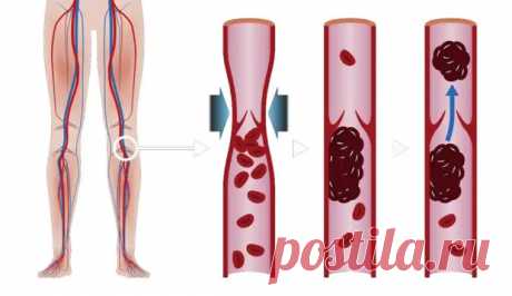 Признаки и симптомы тромбоза глубоких вен - ПолонСил.ру - социальная сеть здоровья - 25 июля - 43982227798 - Медиаплатформа МирТесен