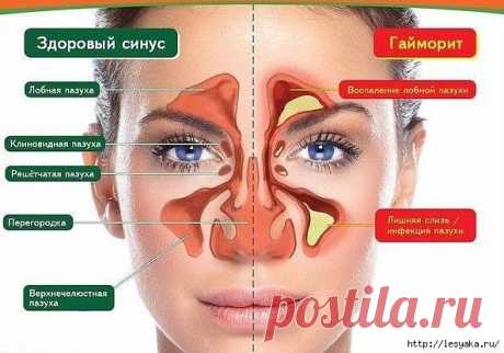 Супер-капли от гайморита и затяжного насморка своими руками!