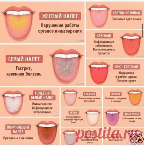 О чем может рассказать цвет языка и налет на нем Язык является одним из наиболее важных индикаторов состояния здоровья всего организма. У здорового человека язык бледно-розового цвета, на нем хорошо различимы сосочки и продольная складка. Некоторое количество белесоватого налета не служит причиной для беспокойства, если он легко...