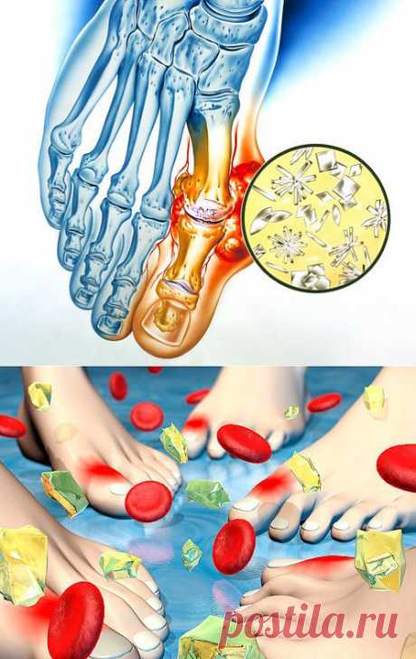 Подагра (подагрический артрит) - Здоровье ног - Infomed