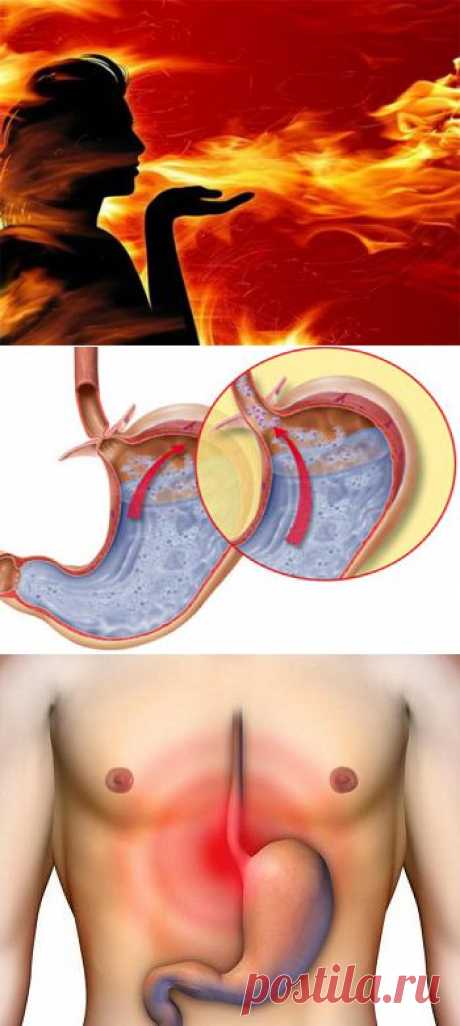 Лечим изжогу народными средствами / Будьте здоровы
