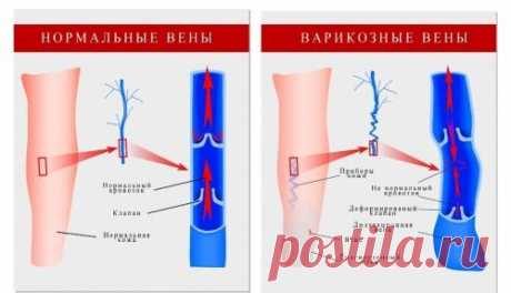 Как предотвратить тромбофлебит и варикозное расширение вен!