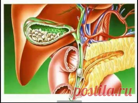 ***Как избавиться от камней в желчном пузыре? Эндорфинотерапия.
