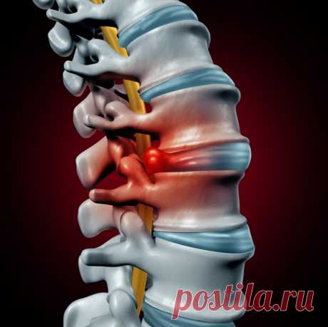Від грижі міжхребцевого диска можна позбутися, якщо знаєш цей рецепт з 3 інгредієнтів | Отож-бо