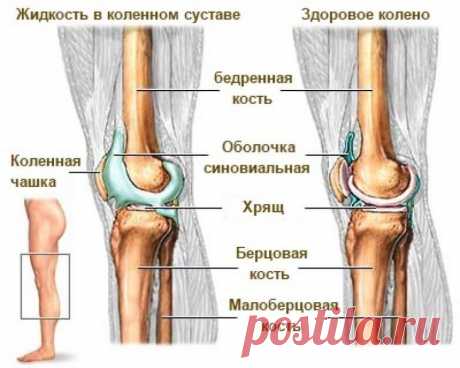 Жидкость в коленном суставе? Смотрите простейший способ избавиться от нее!