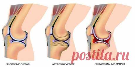 8 рецептов для очищения суставов / Будьте здоровы