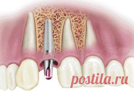 Зубные импланты: краткий, но необходимый ликбез