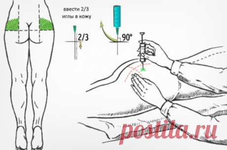 Как пpaвильно делать инъекции? Важная информация!

Внутpимышечная инъeкция — самый распространенный и наиболее простой способ введения в организм лекарственных средств. Такие уколы рекомендуется делать в наиболее крупные мышцы в тех местах, которые отдалены от основных кровеносных сосудов и нервов.

Чаще всего, для инъекции в ягодицу используют 3 или 5 кубовые шприцы. После проведения укола внутри мышечной ткани образуется депо, из которого препарат попадает в кровь и разн...