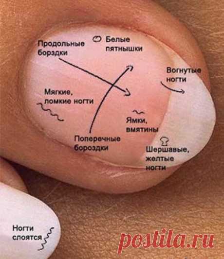 Диагноз по ногтям | ПолонСил.ру - социальная сеть здоровья