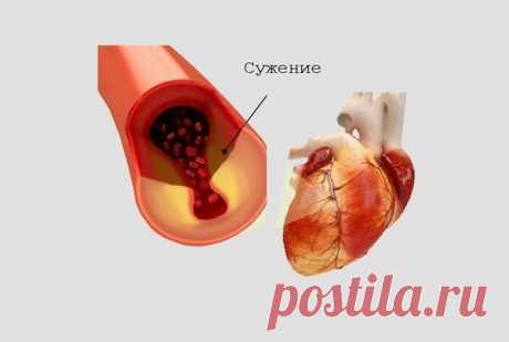 👨‍⚕Стенокардия может привести к инфаркту. Как этого избежать? | Доктор Малышев | Яндекс Дзен