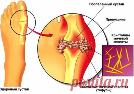 Как быстро снизить уровень мочевой кислоты в домашних условиях - медиаплатформа МирТесен