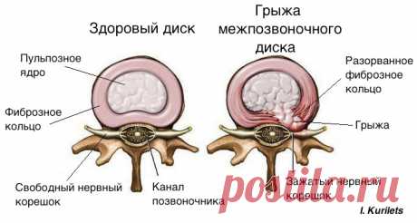 Грыжа диска: вместо операции попробуй это решение! Смотри ВИДЕО - Важное