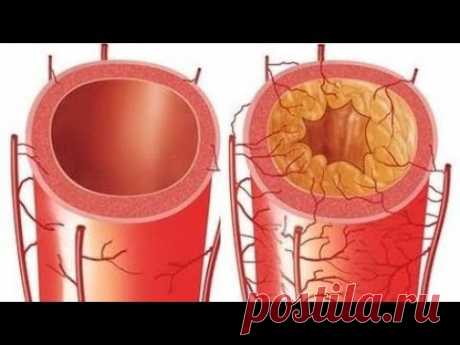 Единственный способ чистки сосудов (артерий и вен)