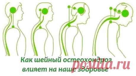 БОЛИТ ШЕЯ? КАК ШЕЙНЫЙ ОСТЕОХОНДРОЗ ВЛИЯЕТ НА НАШЕ СОСТОЯНИЕ. 
На начальном этапе изменения претерпевают кости и связки. И о том наш организм сигнализирует периодической болью или нарушением чувствительности отдела, пораженного остеохондрозом. Затем появляются трещины и меняется высота стояния диска, а точки прикрепления мышц и связок, принадлежащие двум соседним позвонкам, сближаются. 
Поэтому мышцы и связки провисают и позвонки начинают легко соскальзывать или смещаться относительно друг друг