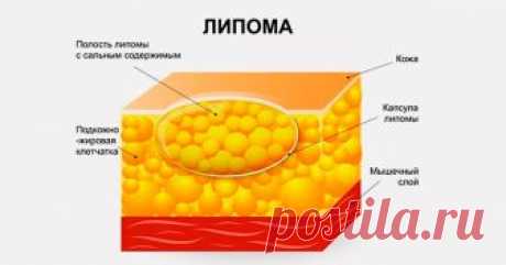 Вот, как избавиться от липомы быстро и легко! 4 народных рецепта со 100% эффективностью! Если липома появилась, сразу предпринимайте меры! Не затягивайте с визитом к врачу! Липома — это доброкачественная опухоль, которая состоит из жировой ткани. Она не доставляет особого дискомфорта, но...