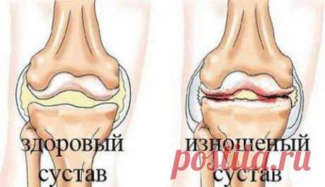 Рецепт настойки из алоэ, нашатыря и скипидара от боли в суставах.