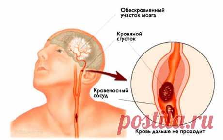 Инсульт: это поможет спасти жизнь себе и близким!