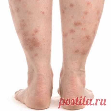 Псориаз на ногах - симптомы, диагностика, лечение Как и чем проявляется псориаз на ногах. Как диагностировать данную патологию, чего стоит избегать. Как эффективно лечить данное заболевание.