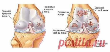 Почему хрустят суставы. Что мы должны об этом знать.