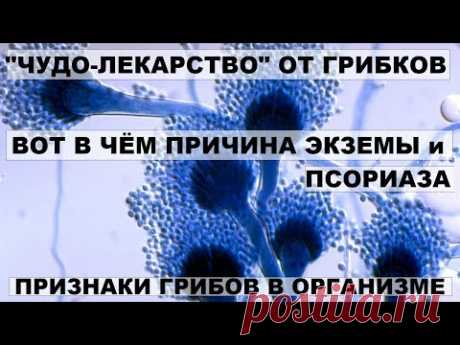 КАК ИЗБАВИТЬСЯ ОТ ГРИБКОВЫХ ЗАБОЛЕВАНИЙ с помощью чистотела. Признаки грибов в организме - YouTube