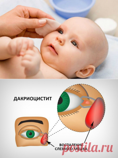 Как правильно делать массаж при дакриоцистите маленьким детям и взрослым, когда он поможет