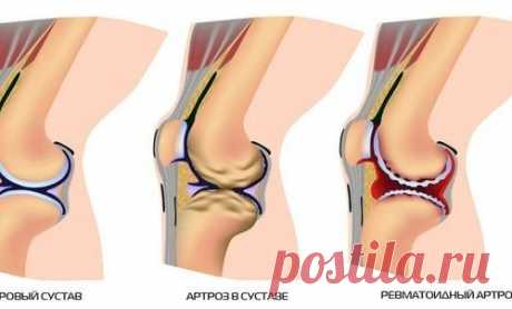 8 рецептов для очищения суставов.