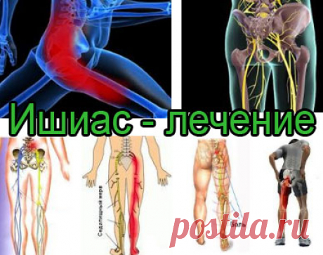 ИШИАС – СИМПТОМЫ И НАРОДНЫЕ СРЕДСТВА ЛЕЧЕНИЯ ВОСПАЛЕНИЯ СЕДАЛИЩНОГО НЕРВА.