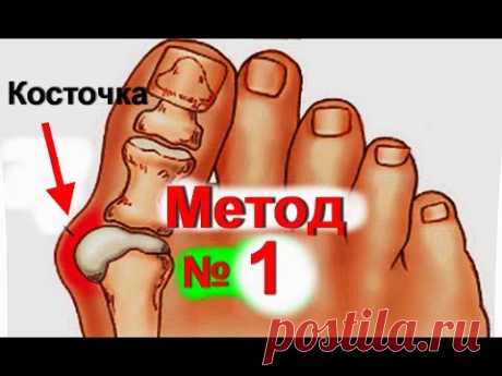 Вальгусная деформация стопы и выпирающая косточка на ноге это не красиво и довольно болезненно. Шишки на ногах очень часто встречаются у женщин. Достаточно м...