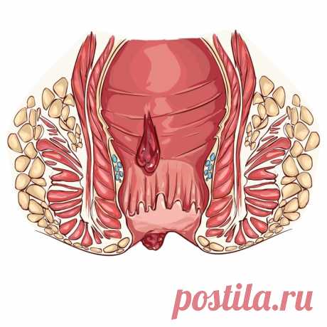 Два раза в день по 20 минут сиди в соленой воде, и никакой операции не нужно! Непросто жить с болезненной пульсирующей шишкой внутри — не можешь сидеть, стоять, даже поход в туалет превращается в агонию. Эта неприятное заболевание, вызванное чрезмерным давлением на вены в области прямой кишки и таза, способно сильно испоганить каждый день твоей жизни.





Воспаленные на