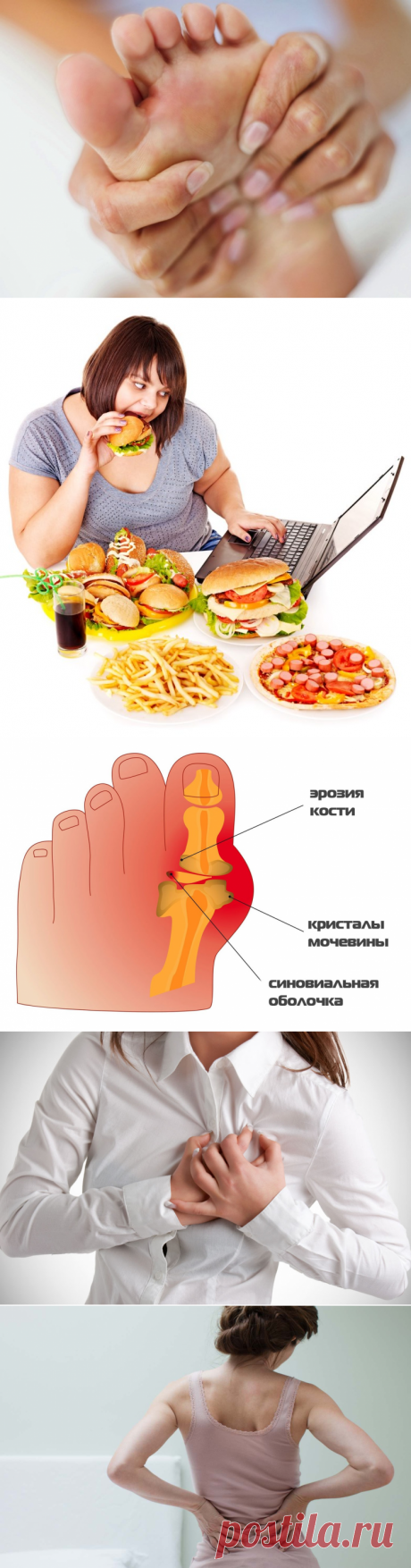 Что такое подагра: признаки, симптомы и лечение болезни