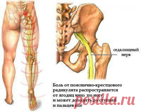 Оказание первой помощи и несколько нехитрых правил при &quot;простреле&quot; (люмбаго) | Мамам, женщинам, бабушкам и очень любознательным.